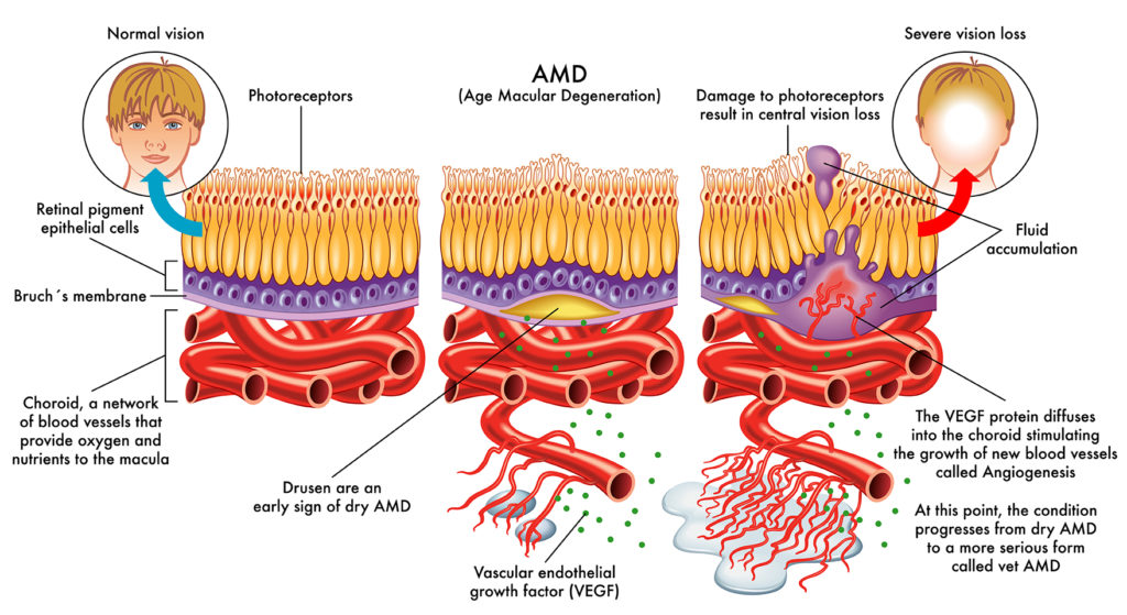 age-macular-degeneration