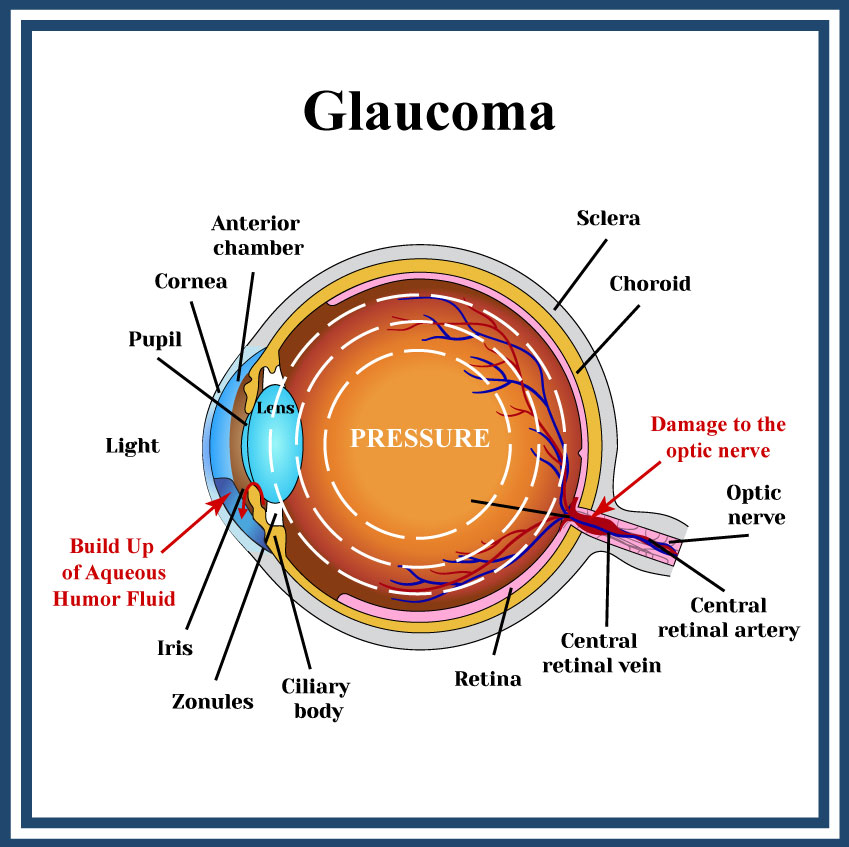 converted-glaucoma