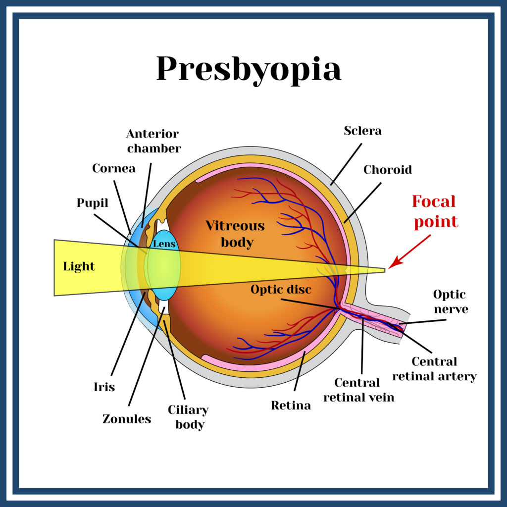 converted-presbyopia