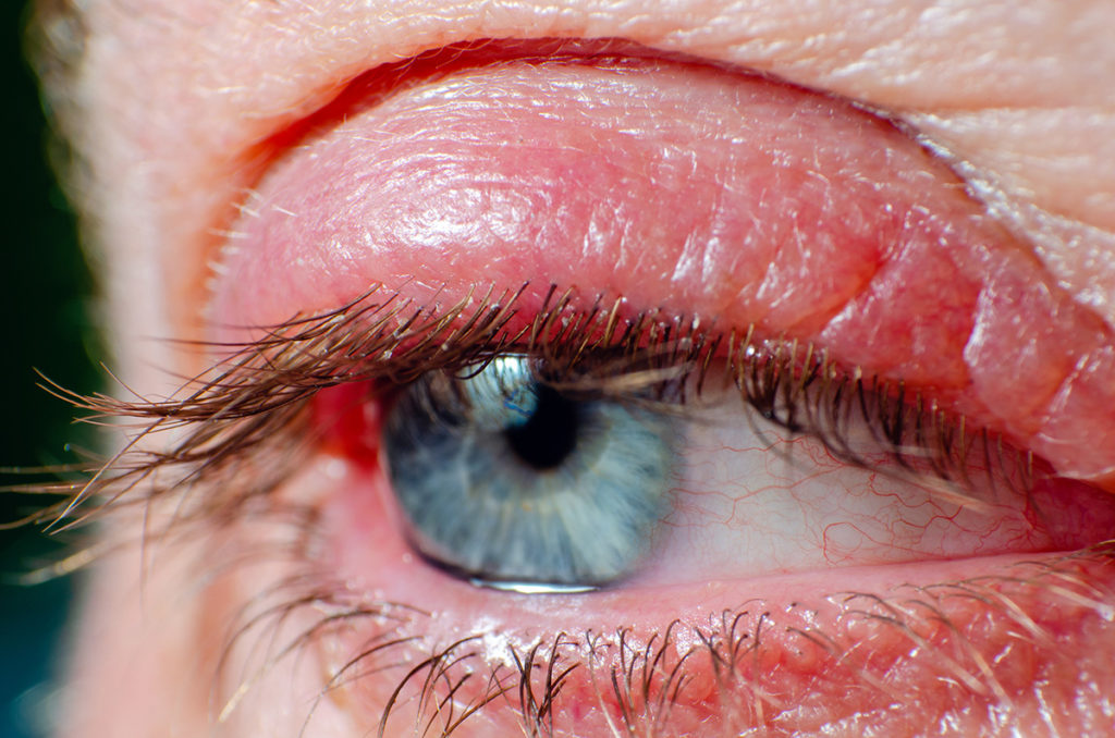 inflamed-eyelid